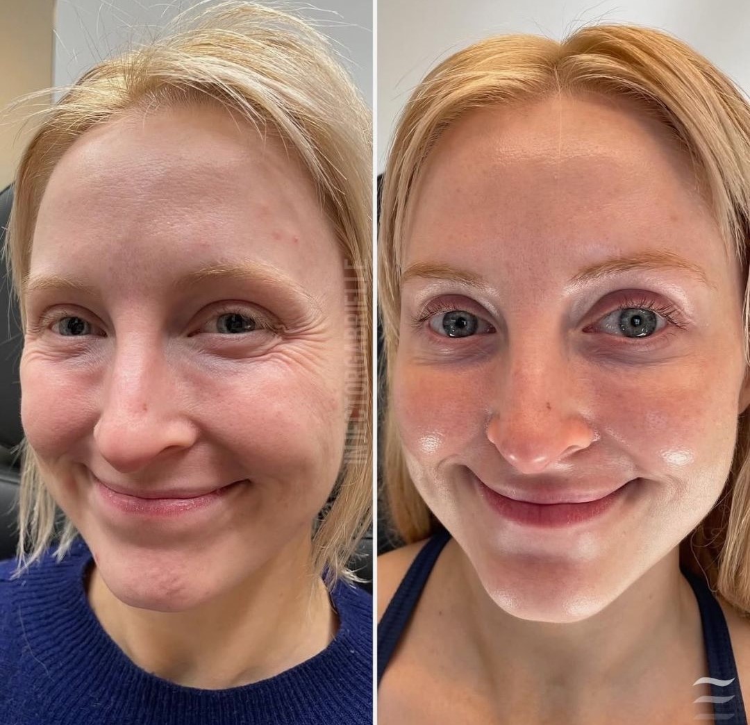 Under-Eye Filler Results